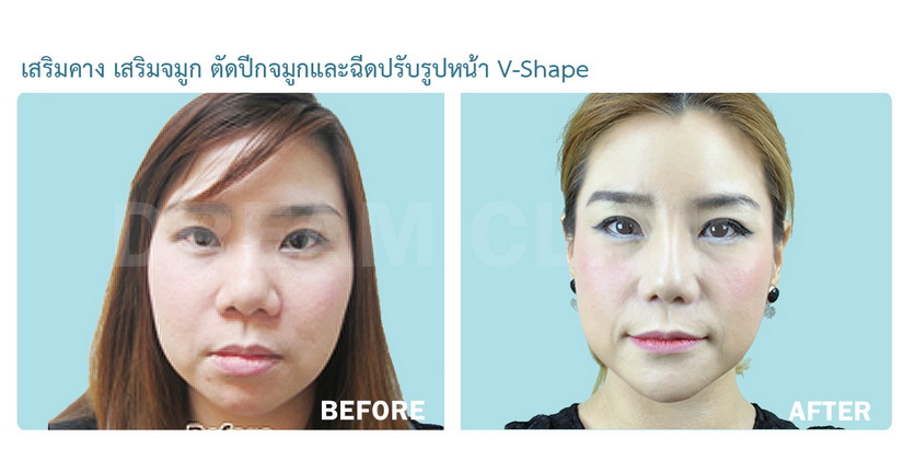 Chin Reduction 07