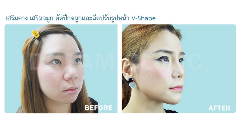 Chin Reduction 08