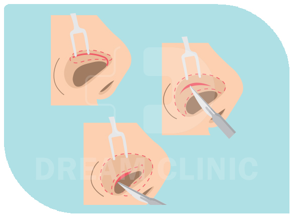 Close nose surgery