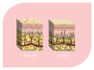 Injection Lipolysis