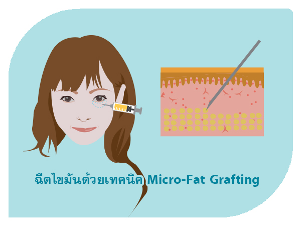 Microfat eye