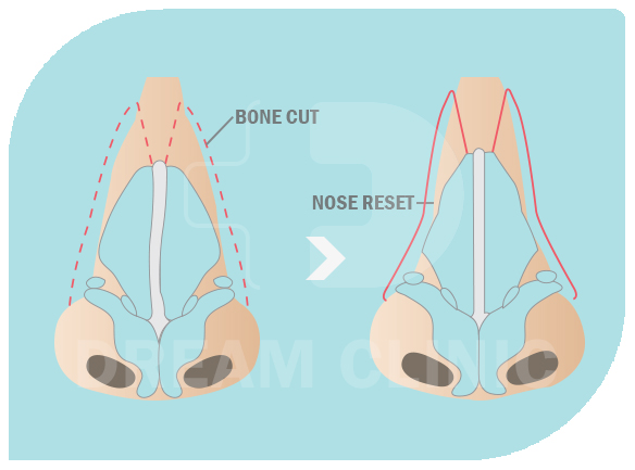 Nose Reduction 021