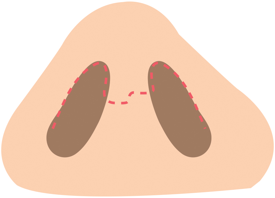 Open nose surgery 01