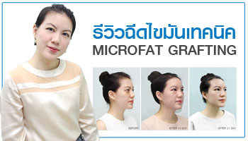 ฉีดไขมันหน้าผาก ฉีดไขมันใต้ตา microfat