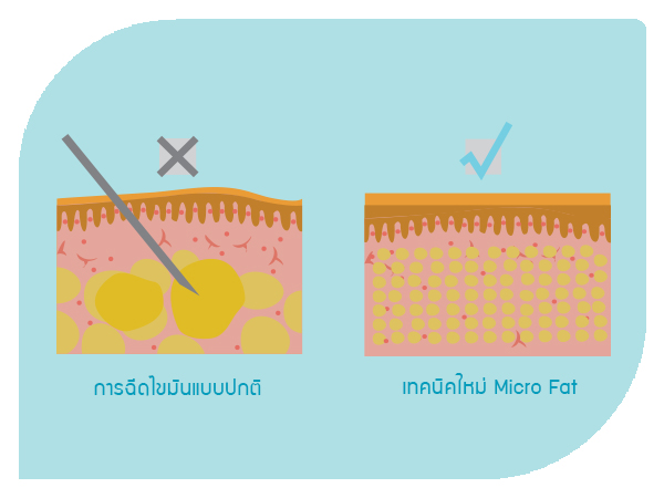 เทคนิคใหม่ Micro fat