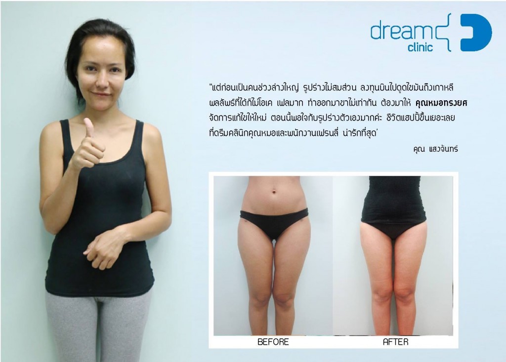 แก้ไข ดูดไขมัน VASER ไม่เรียบ dream clinic