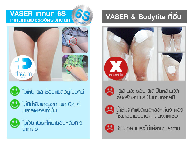 Vaser ดีกว่า Bodytite