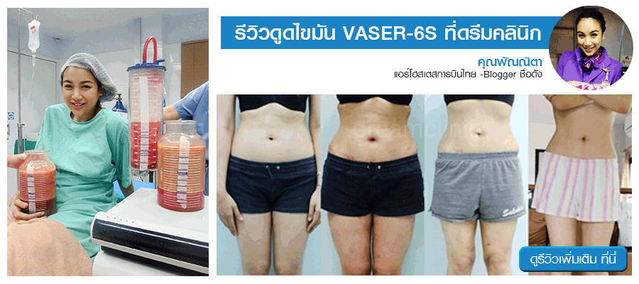 vaser liposuction 6s