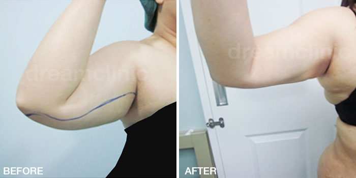 vaser-arm