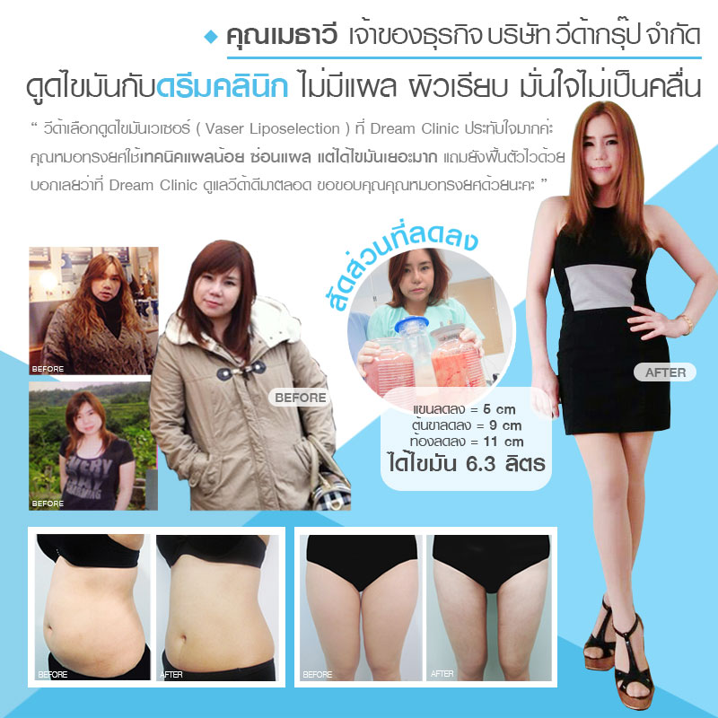 รีวิวดูดไขมันเวเซอร์