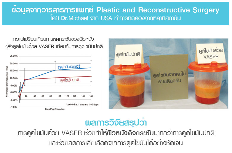 เปรียบเทียบดูดไขมันเวเซอร์