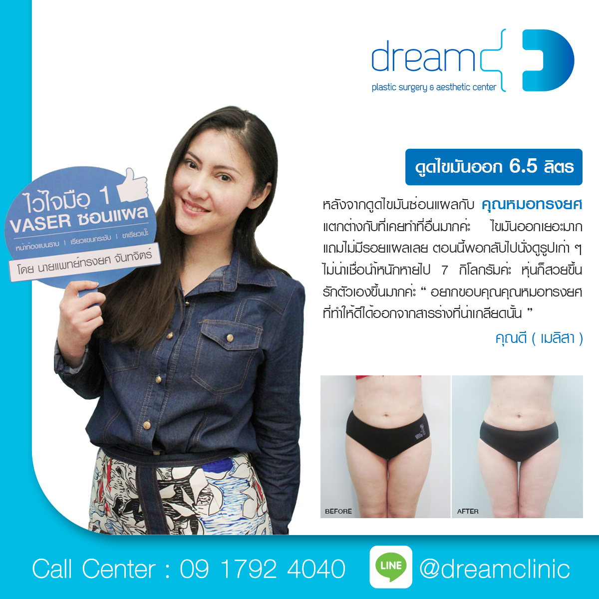 vaser ซ่อนแผล dream clinic หมอทรงยศ