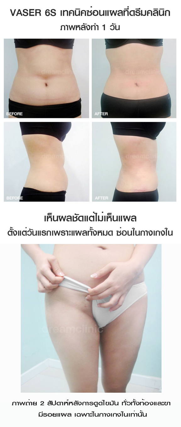 ซ่อนแผล vaser dream clinic หมอทรงยศ