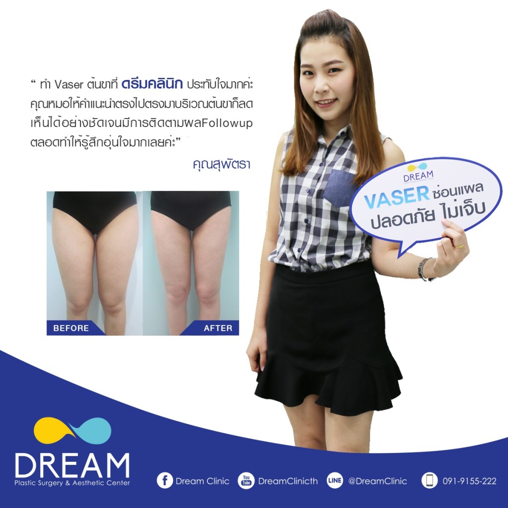 vaser ดูดไขมัน ลดต้นขา