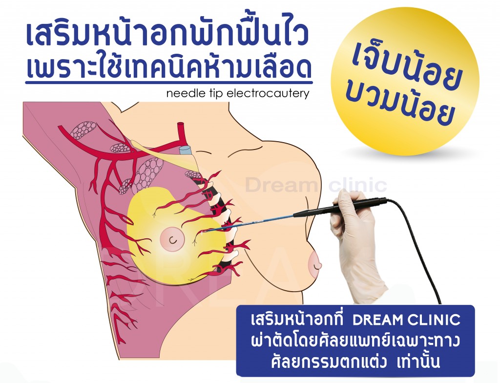 เทคนิคพิเศษ บวมช้ำน้อย needle tip electrocautery