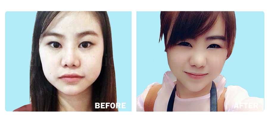 before after LLD botox dream clinic ปรับรูปหน้า หน้าเรียว V-shape