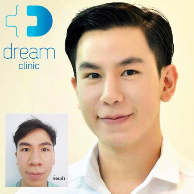 เสริมปลายจมูก ตัดปีก ลดขนาดปีกและปลายจมูก dream หมอทรงยศ