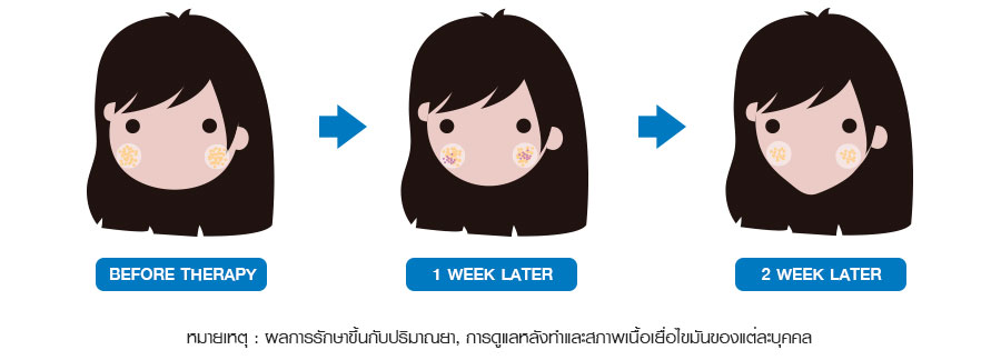 LLD สลายไขมันแก้ม