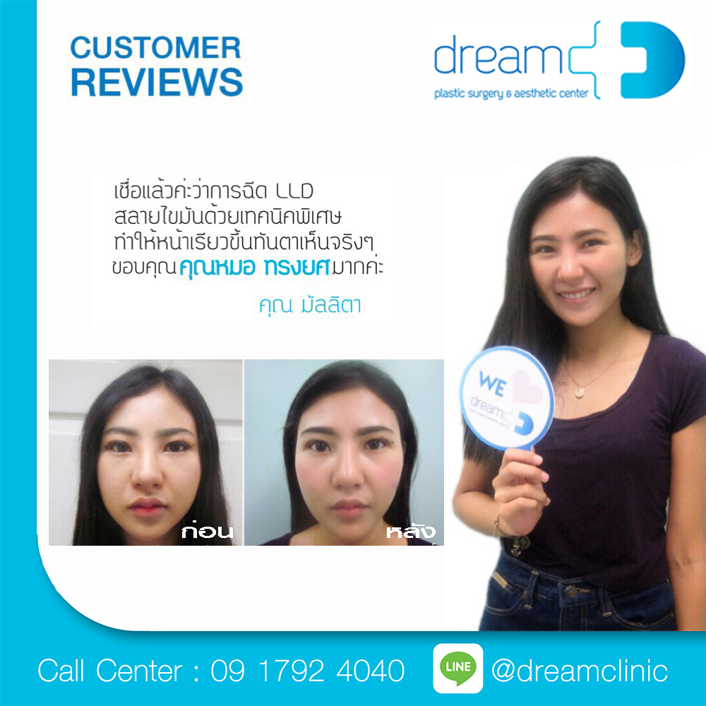 LLD ลดไขมัน ลดแก้ม หน้าวีเชพ Vshape ปรับหน้าเรียว Dream clinic