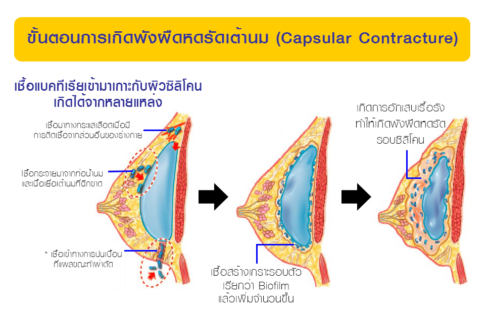 Capsular contracture สาเหตุการเกิดแบคทีเรียปนเปื้อน Biofilm