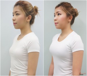 before after เสริมหน้าอก breast dream clinic