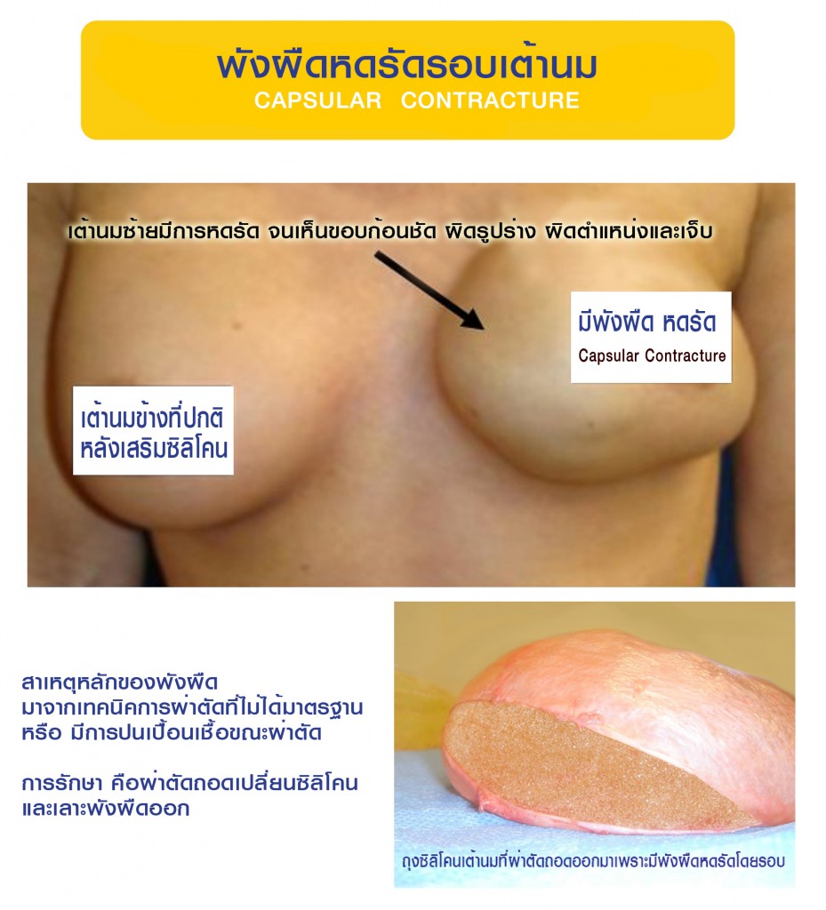 พังผืดหดรัด เต้านมผิดรูป แข็ง เจ็บ หลังเสริม capsular contracture