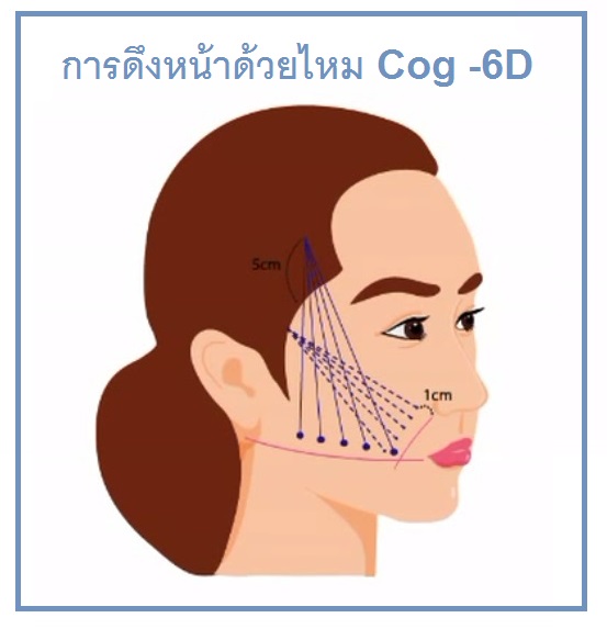 cog diagram ดึงหน้าด้วยไหมก้างปลา Cog ดรีมคลินิก