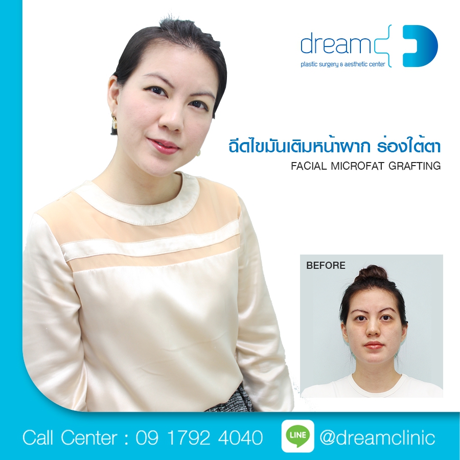 Dream microfat grafting หมอทรงยศ ฉีดไขมันตัวเอง ใบหน้า หน้าผาก ร่องใต้ตา