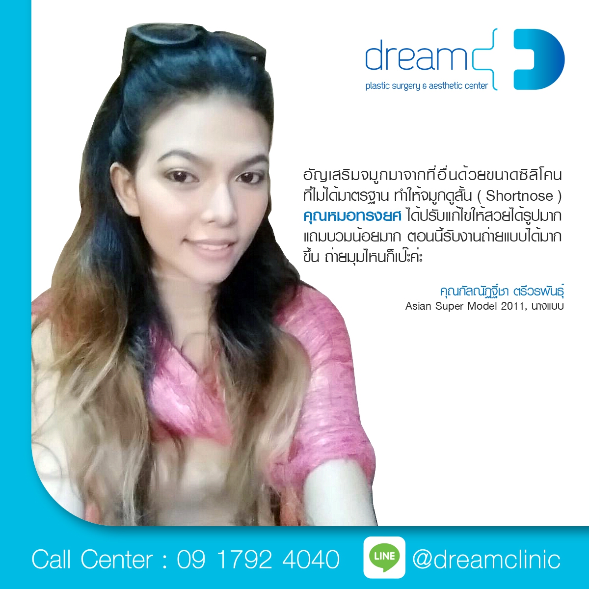 คุณอัญ แก้จมูกสั้น เสริมจมูกปลายหยดน้ำ หมอทรงยศ dream clinic