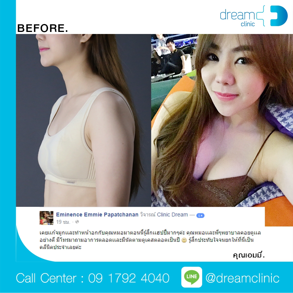 เสริมหน้าอก ทรงกลมม หมอทรงยศ dream clinic