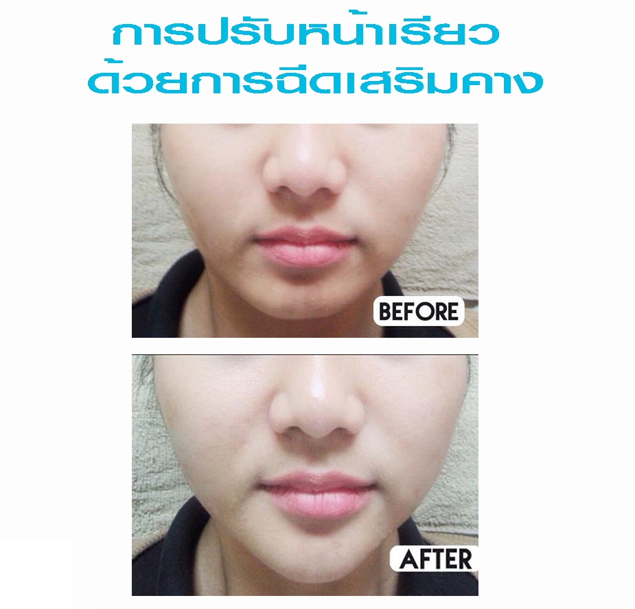 ฉีด filler ฟิลเลอร์ เสริมคาง ปรับหน้าเรียว v-shape