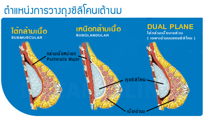 ตำแหน่งการวางถุงซิลิโคนเต้านม