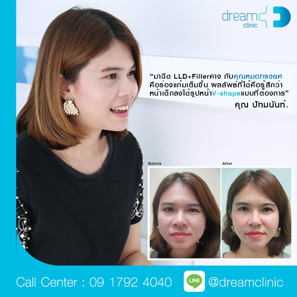 ฉีดปรับหน้าเรียว v-shape LLD  Botox filler คาง