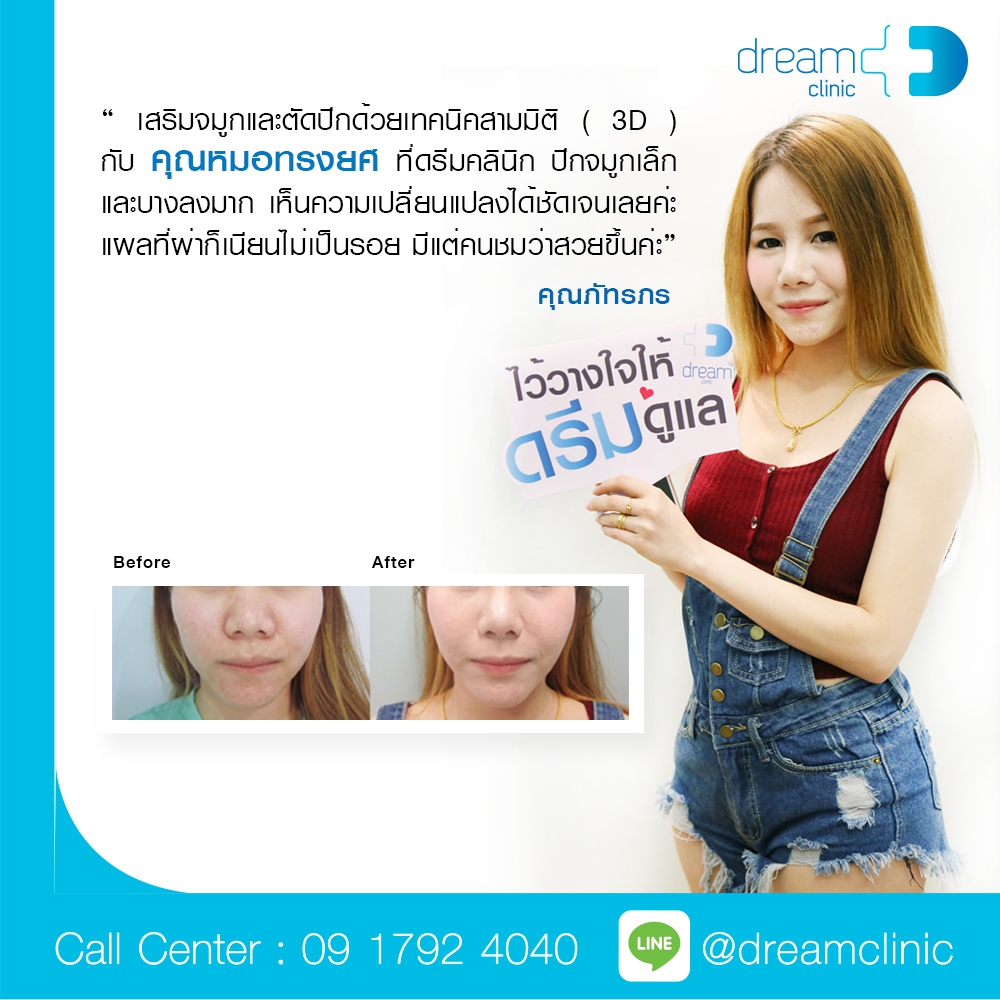 เสริมจมูก ตัดปีกจมูก ลดความกว้าง ลดขนาดจมูก หมอทรงยศ dream clinic