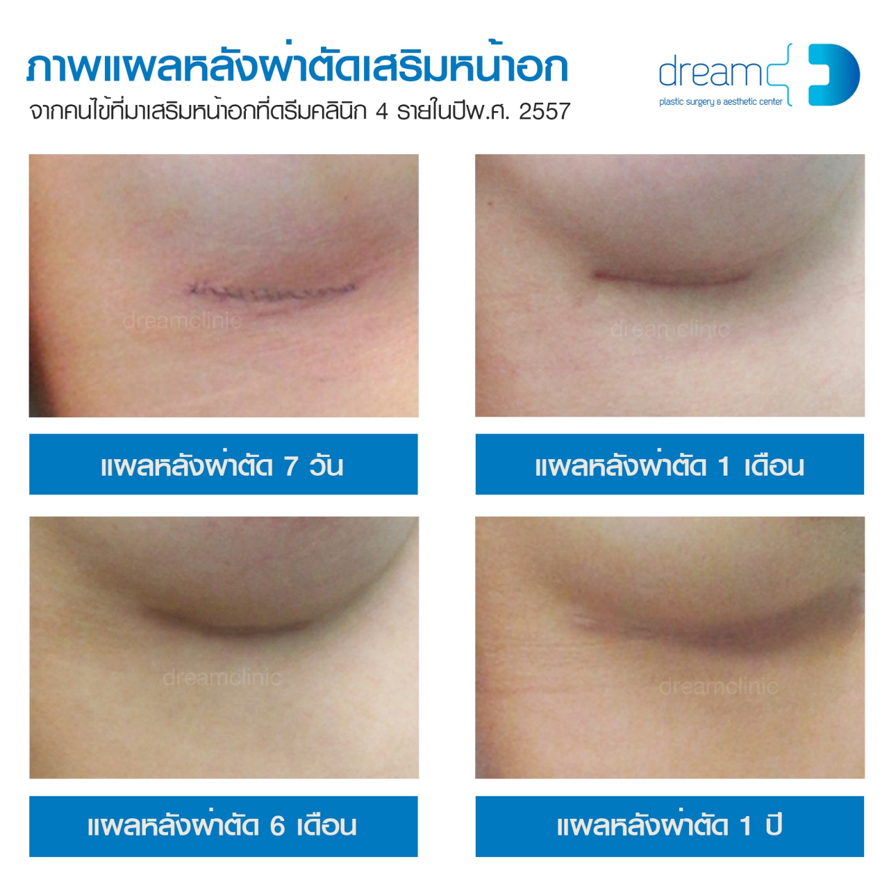 ภาพแผลเป็น หลังเสริมหน้าอก dream clinic หมอทรงยศ