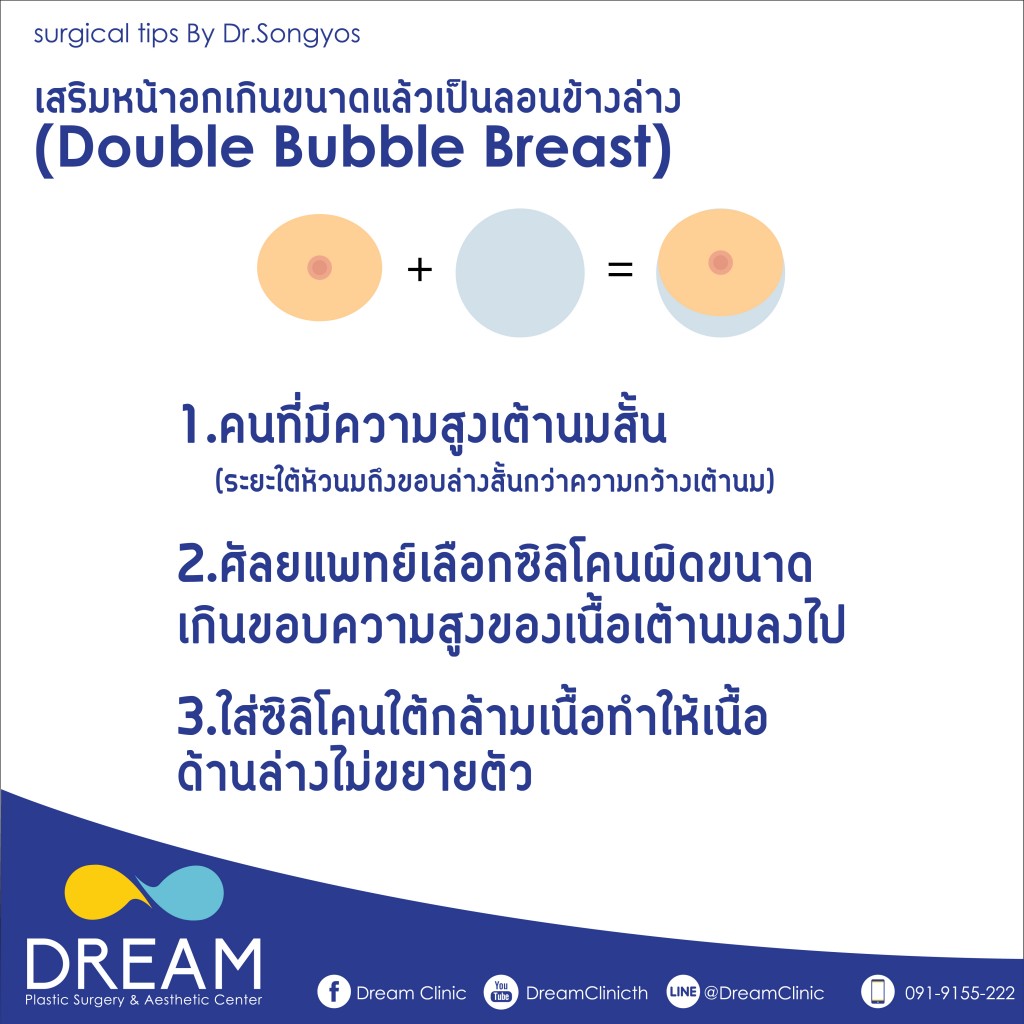 double bubble dream clinc นมเป็นลอนข้างใต้ 2