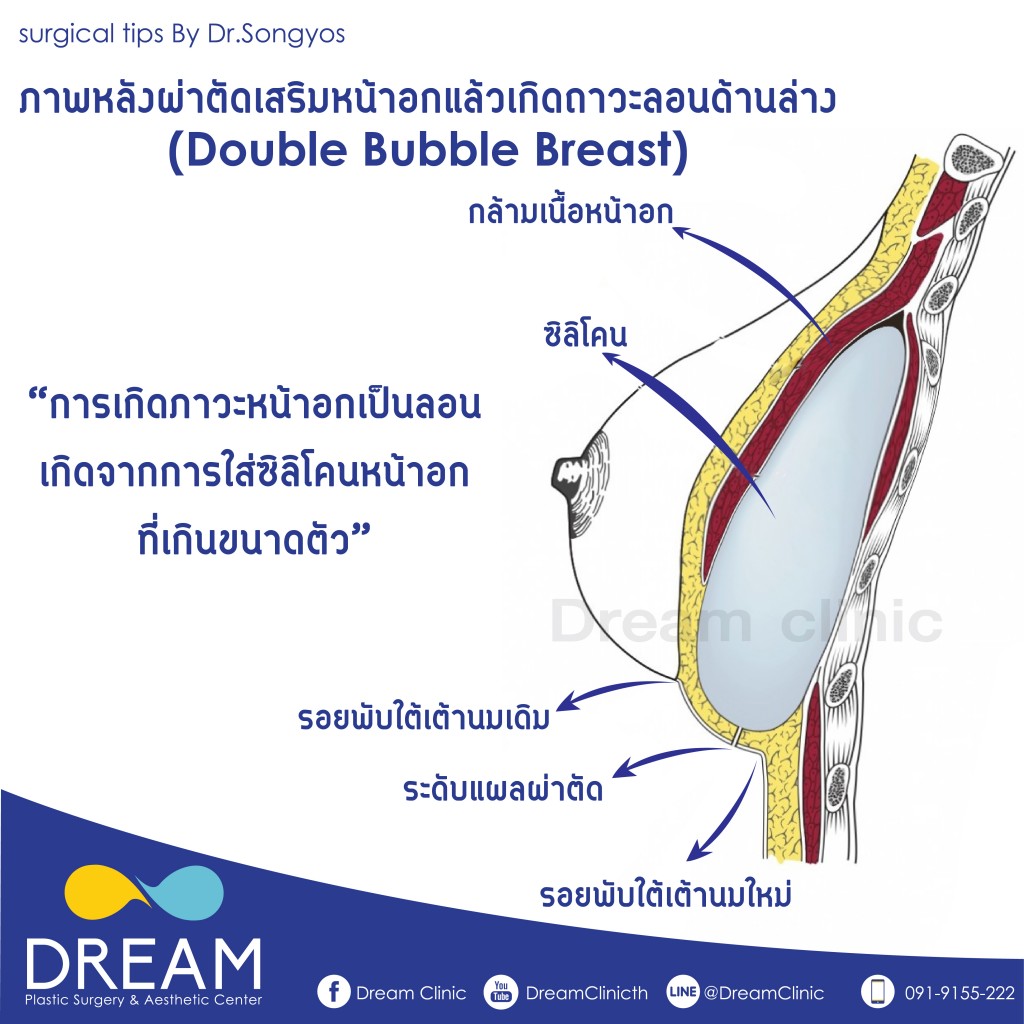 double bubble  dream clinc นมเป็นลอนข้างใต้ 3