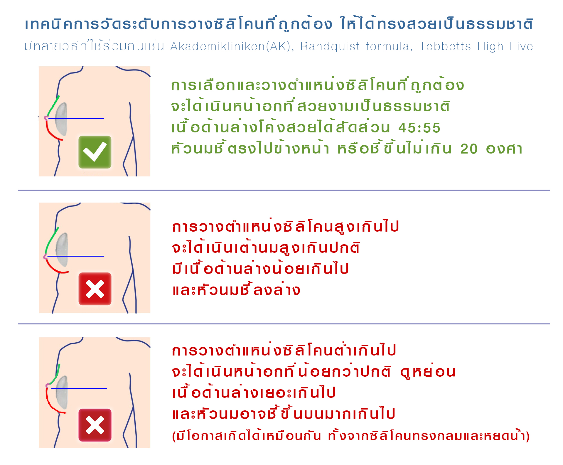 เทคนิคการวางระดับซิลิโคน