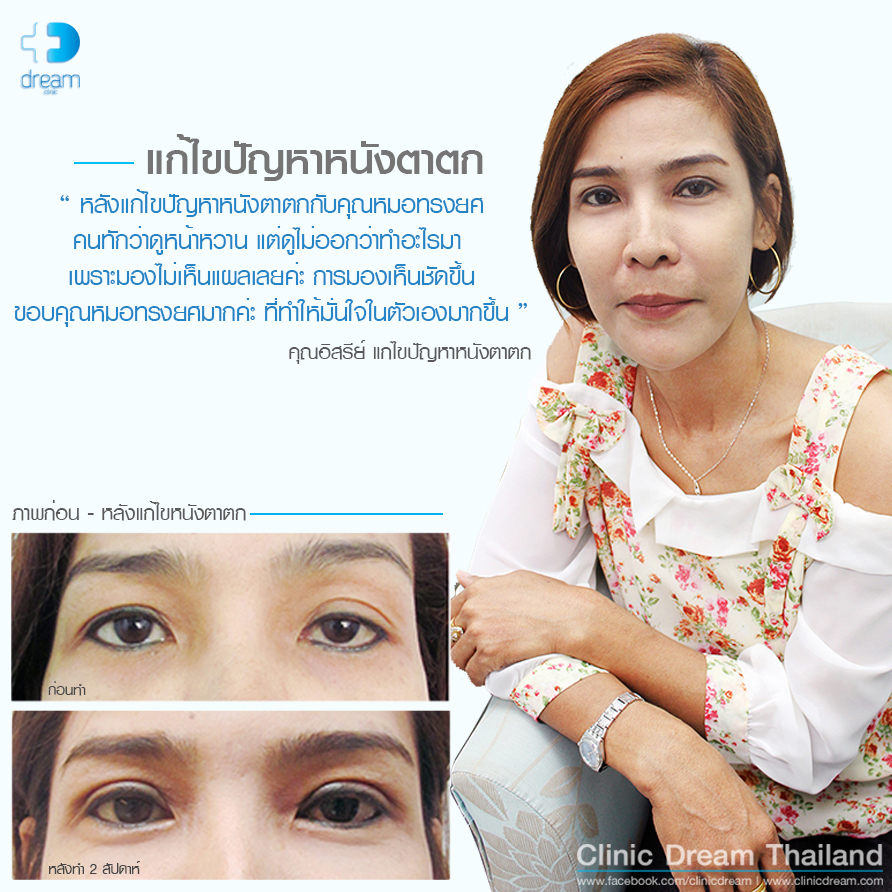 ตาสองชั้น หมอทรงยศ dream clinicTestimonial-แก้ไขหนังตาตก อิสรีย์