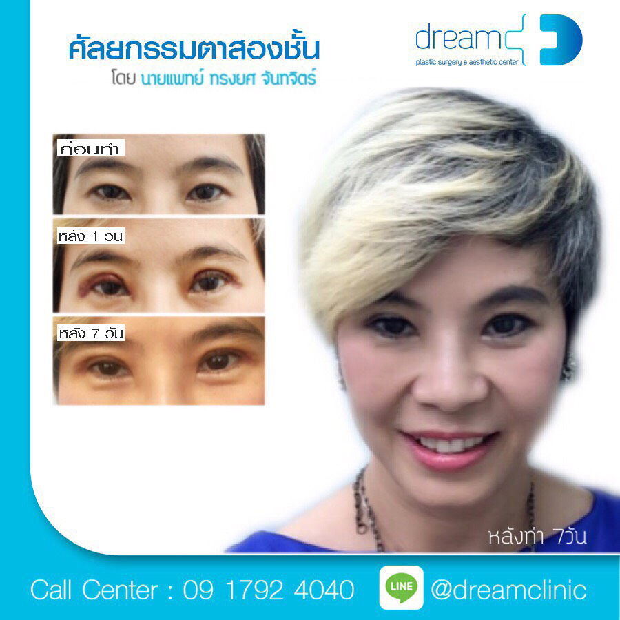 ตาสองชั้น แก้หนังตาตก หนังตาบน dream clinic หมอทรงยศ