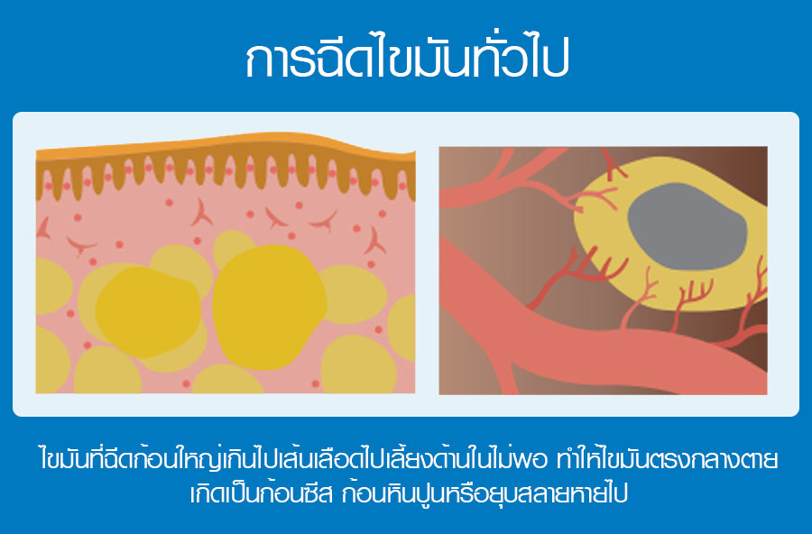 microfat เทคนิค ฉีดไขมัน เสริมหน้าอก ดรีม หมอทรงยศ