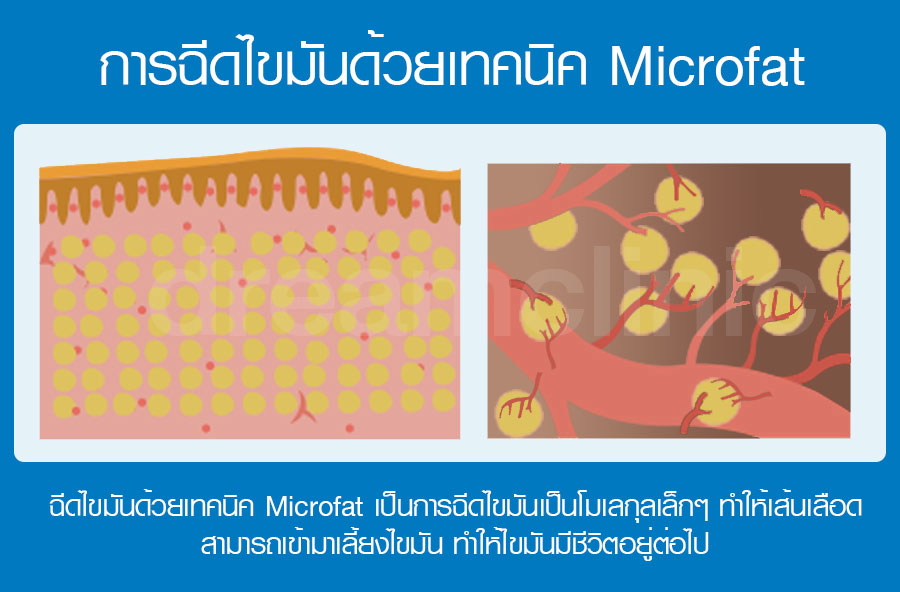 microfat เทคนิค ฉีดไขมัน เสริมหน้าอก ดรีม หมอทรงยศ