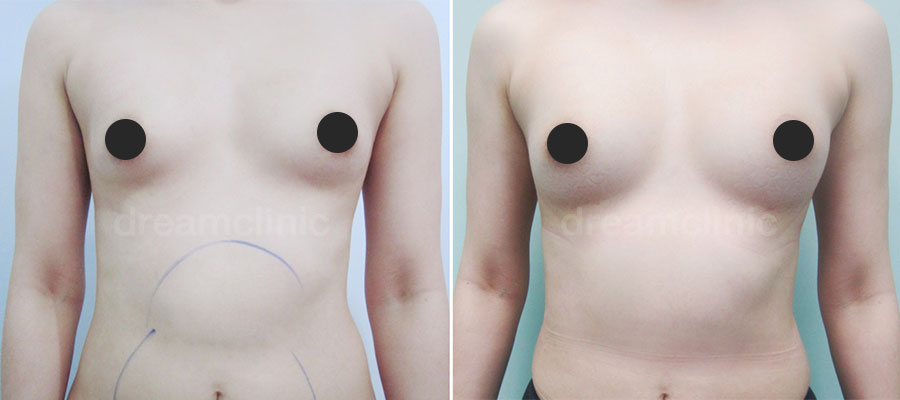 microfat-breast