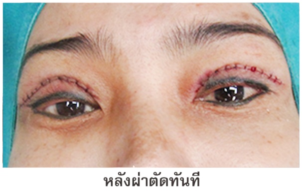 2 ตาสองชั้น แก้ไขหนังตาตก ตาไม่เท่ากัน หมอทรงยศ ดรีม dream clinic