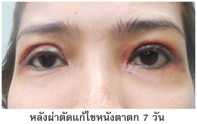 4 ตาสองชั้น แก้ไขหนังตาตก ตาไม่เท่ากัน หมอทรงยศ ดรีม dream clinic