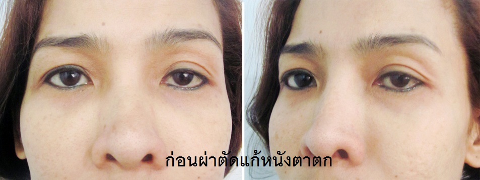 5 ตาสองชั้น แก้ไขหนังตาตก ตาไม่เท่ากัน หมอทรงยศ ดรีม dream clinic