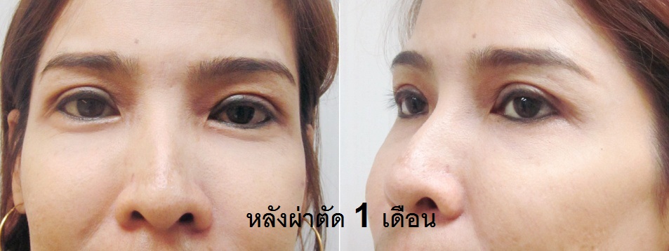 6 ตาสองชั้น แก้ไขหนังตาตก ตาไม่เท่ากัน หมอทรงยศ ดรีม dream clinic