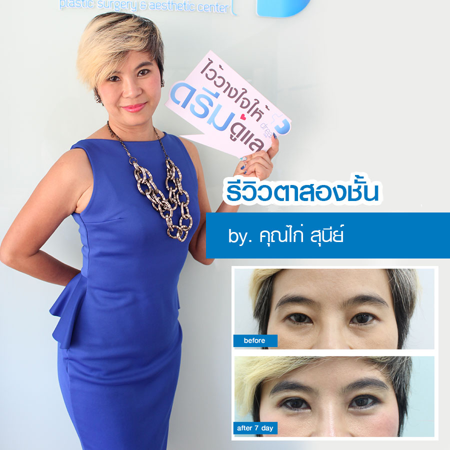 รีวิวตาสองชั้น หนังตาตก ดรีมคลินิก dream clinic หมอทรงยศ