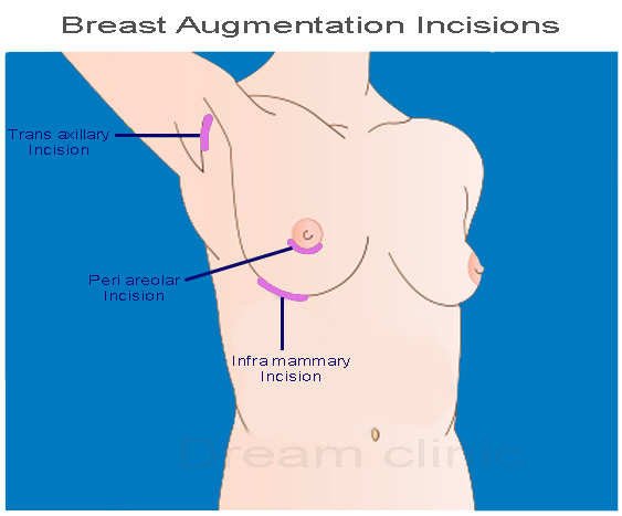 BA incisions