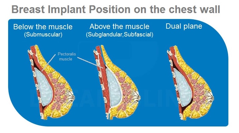 breast implant position